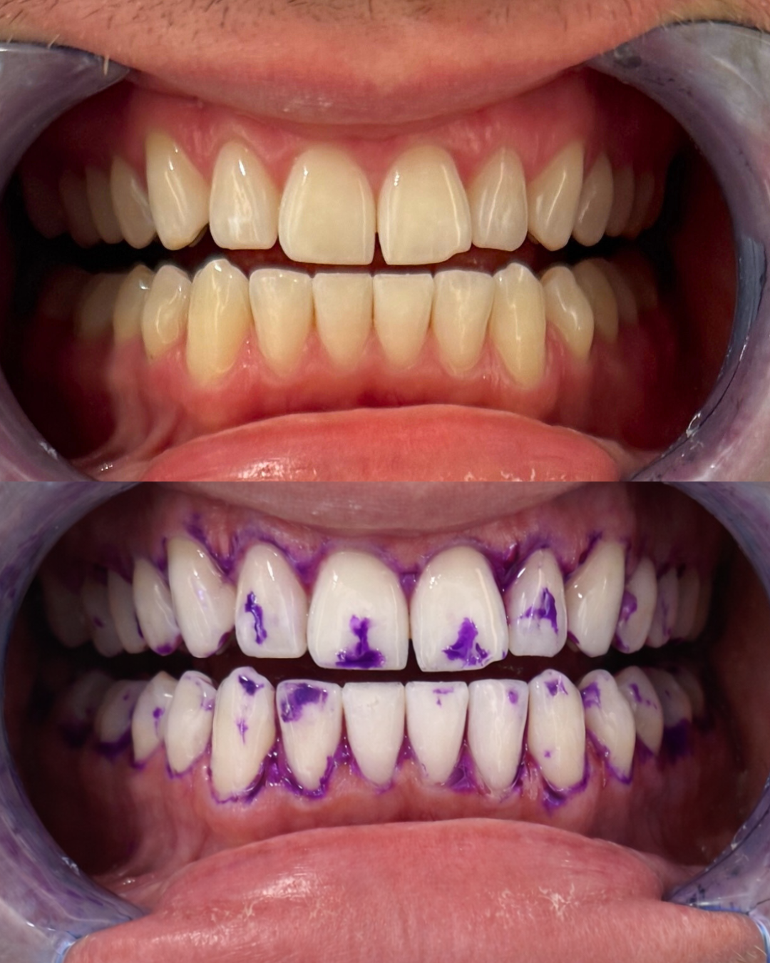 Tannblekingsstrips | 30 minutters bruk | Fleksible strips | BrightStrip